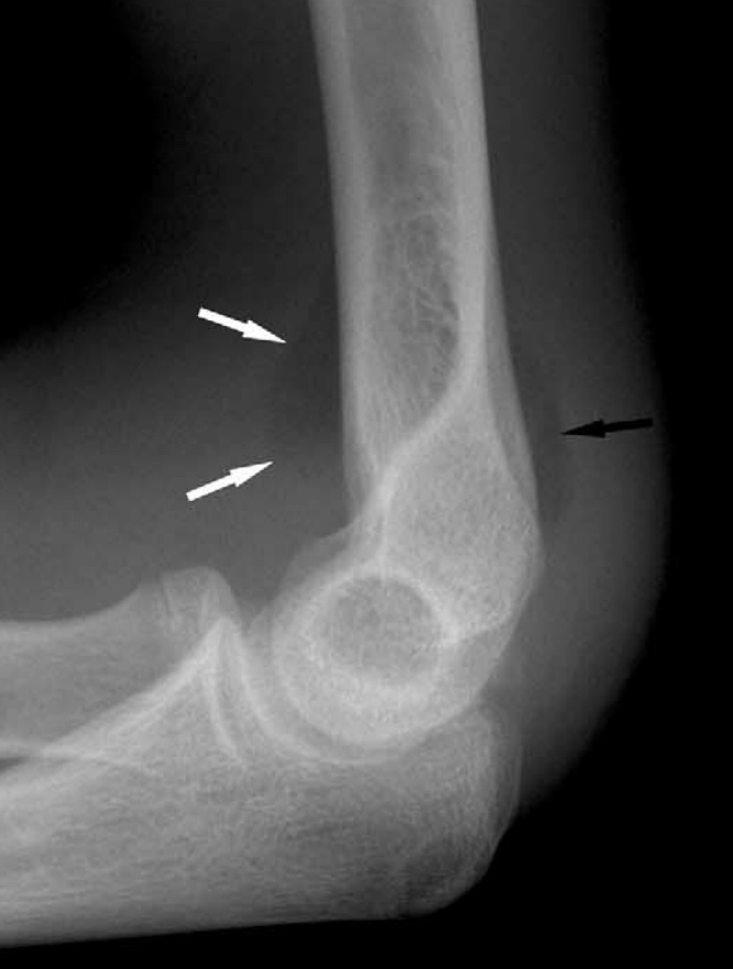 How to screen a paediatric elbow Xray for injuries